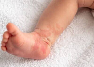 A Parent’s Guide to Port Wine Birthmarks