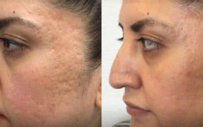 Best Laser for Every Type of Acne Scar
