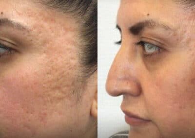 Best Laser for Every Type of Acne Scar