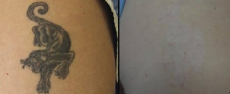 Roy Geronemus MD Port Wine Birthmark Removal in New York