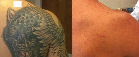 Roy Geronemus MD Port Wine Birthmark Removal in New York