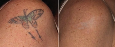 Roy Geronemus MD Port Wine Birthmark Removal in New York