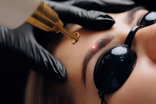 woman receiving permanent makeup removal laser treatment