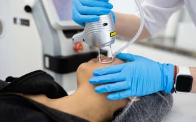 Do Lasers Really Help With Acne Scars? | Your Guide to Real Results