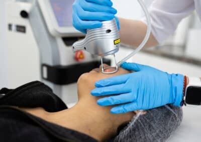 Do Lasers Really Help With Acne Scars? | Your Guide to Real Results