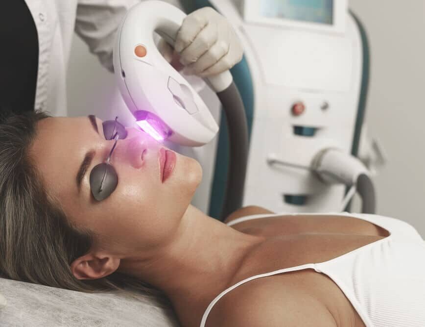 IPL laser treatment