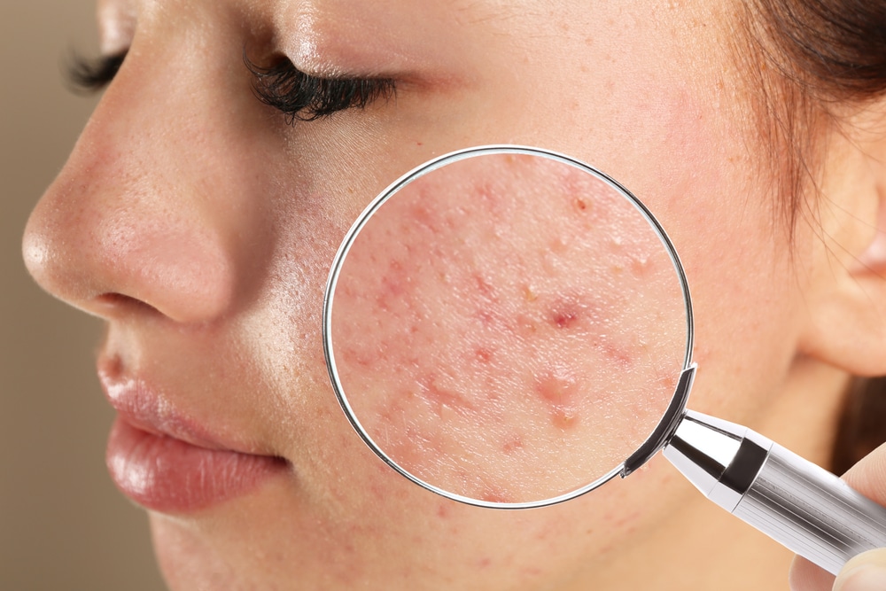 Closeup of active acne, pre-treatment