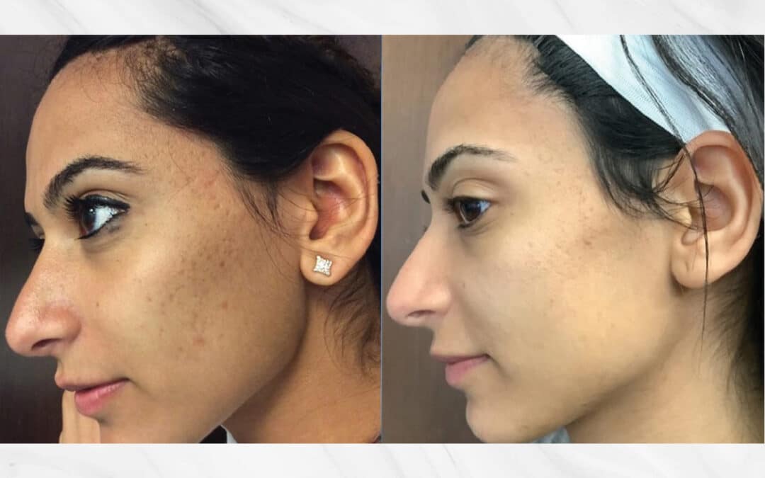 Best Laser for Every Type of Acne Scar