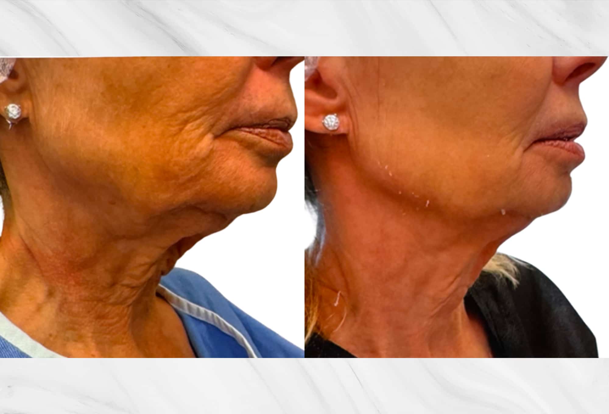 Skin tightening results before and after photos of the neck by Dr. Roy Geronemus