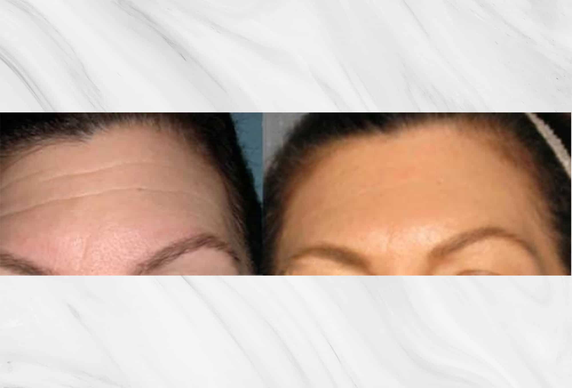 Botox/Neuromodulator treatment before and after results on the forehead by Dr. Roy Geronemus