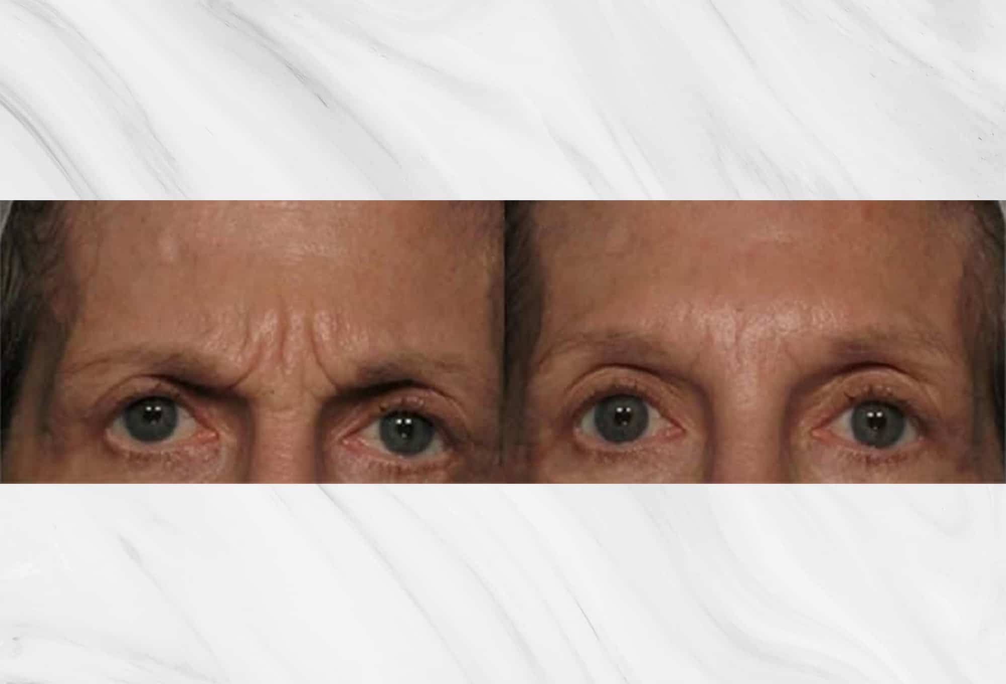 Botox/Neuromodulator treatment before and after results on the forehead by Dr. Roy Geronemus