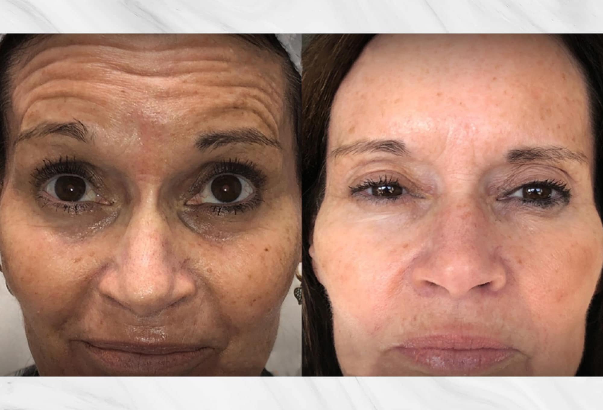 Botox/Neuromodulator treatment before and after results on the face by Dr. Roy Geronemus