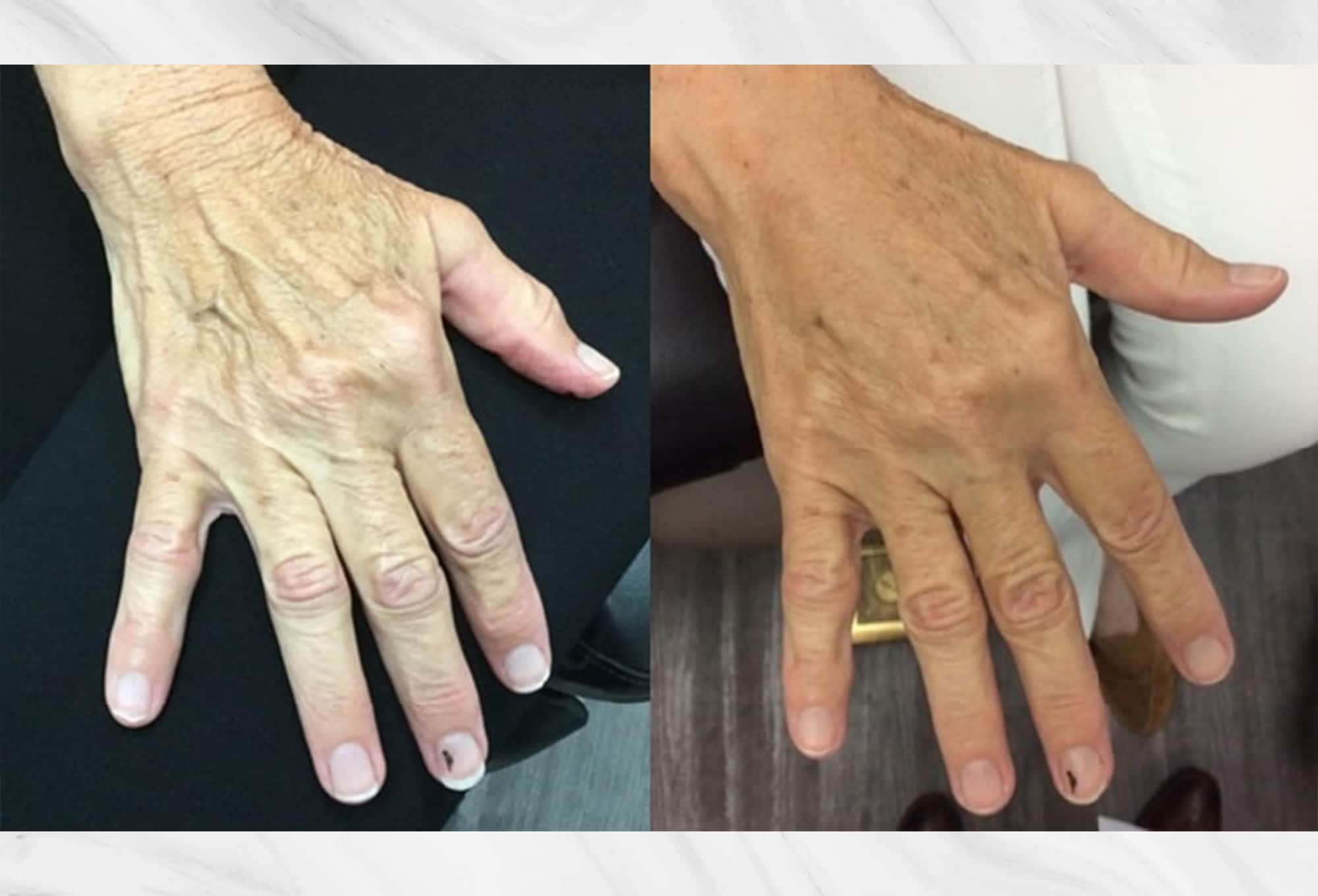 Dermal filler treatment results before and after photos of the hand by Dr. Roy Geronemus