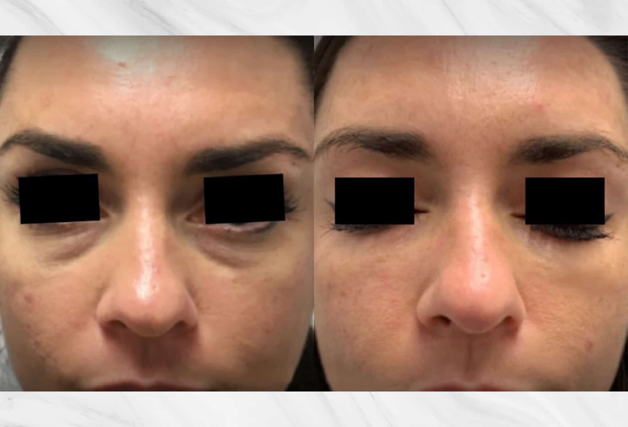 Dermal filler treatment results before and after photos of the face
