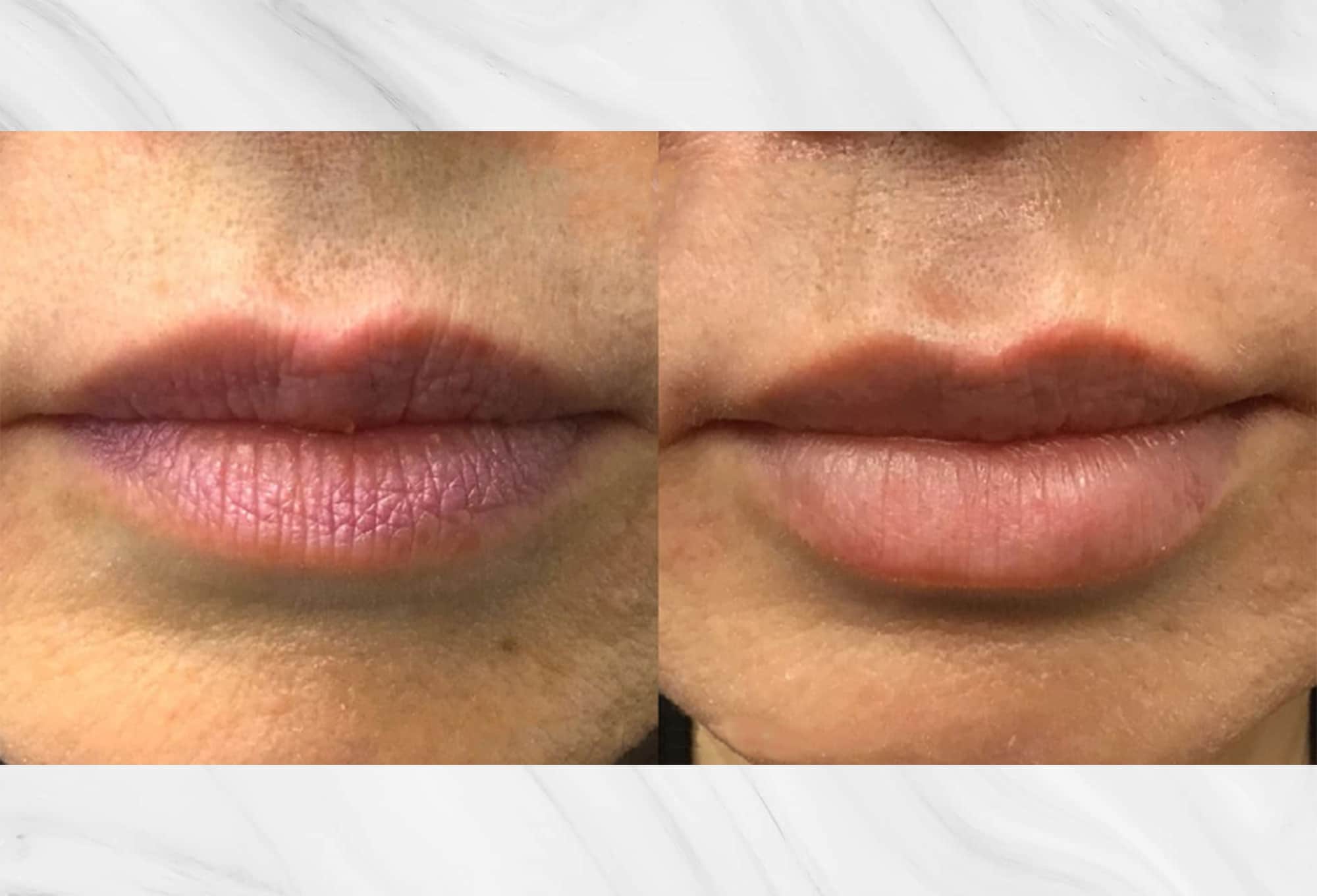 Dermal filler treatment results before and after photos of the lips by Dr. Roy Geronemus