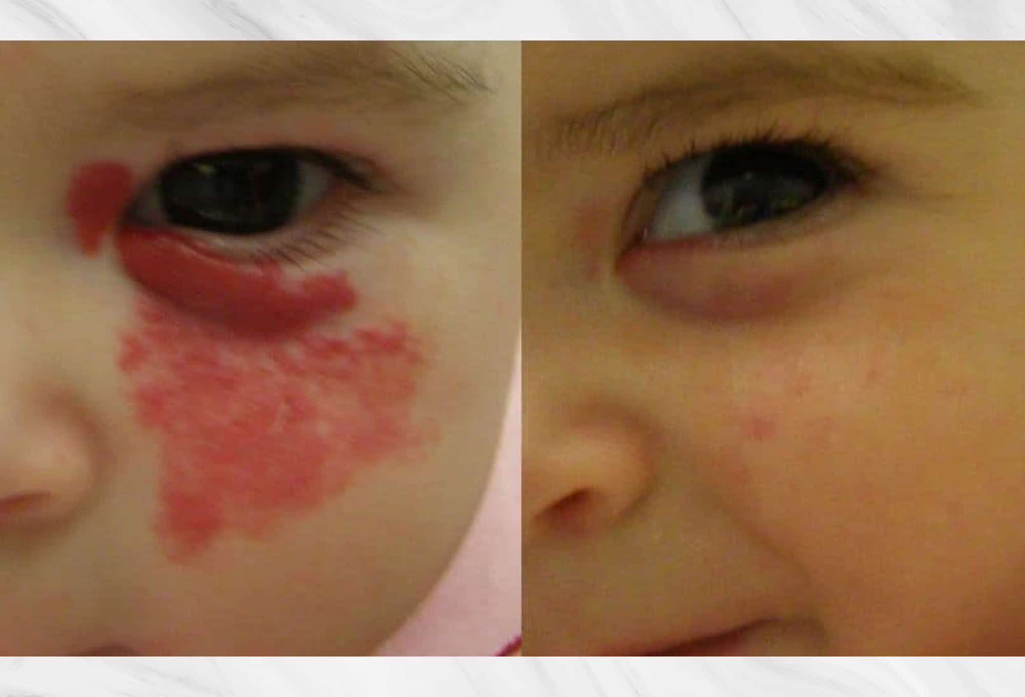 Hemangioma Before and after photo of a child female patient