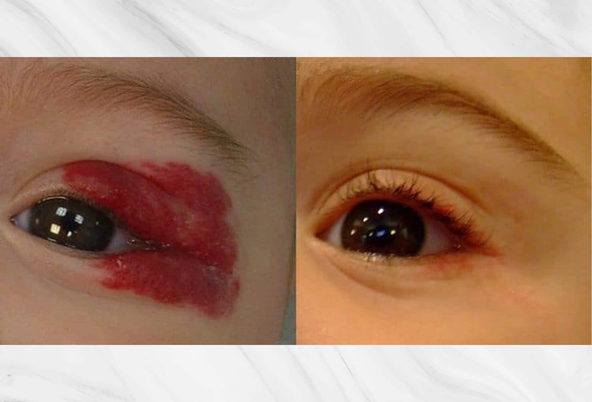 Hemangioma below nose before and after results of a patient