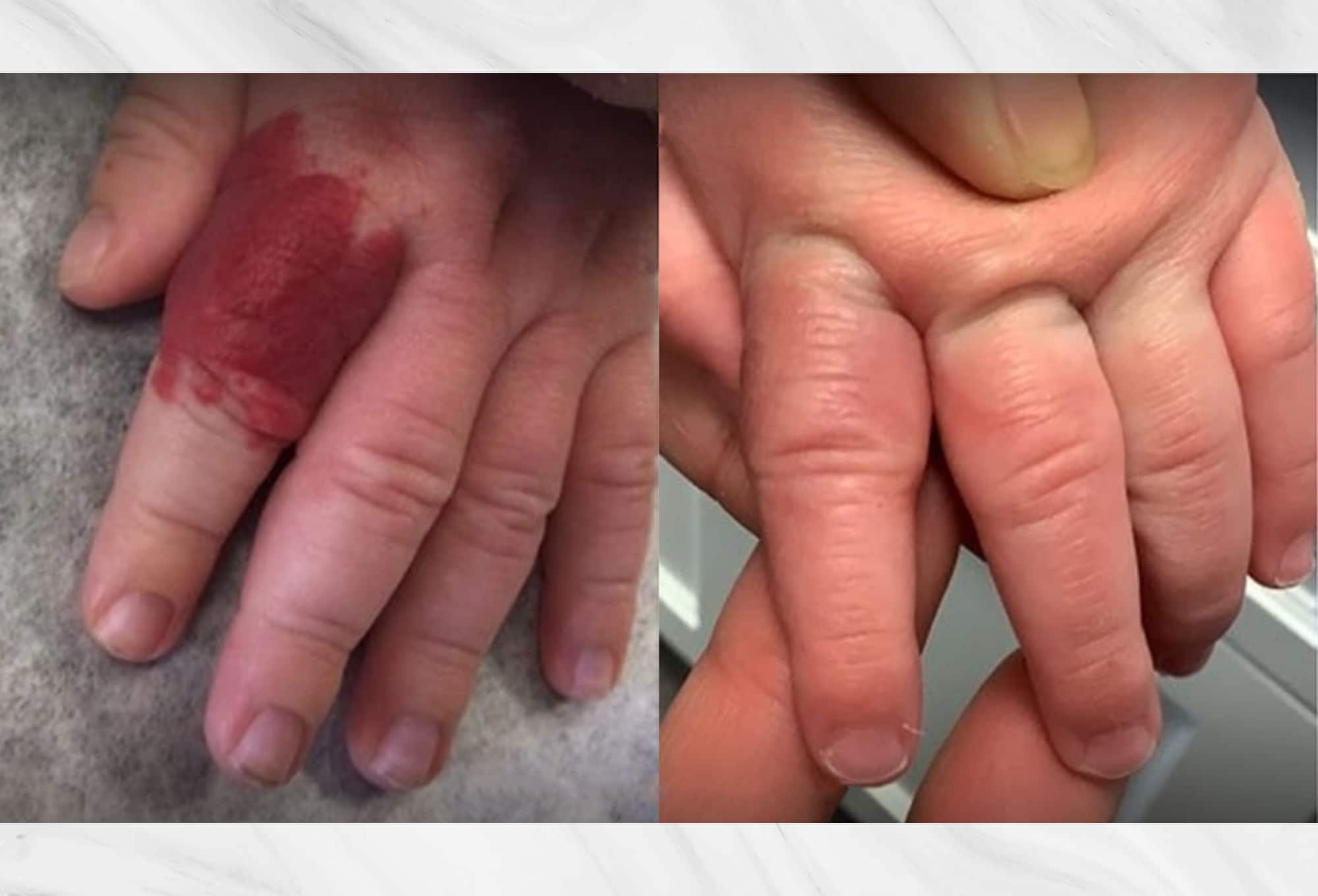 Hemangioma below an eye before and after results