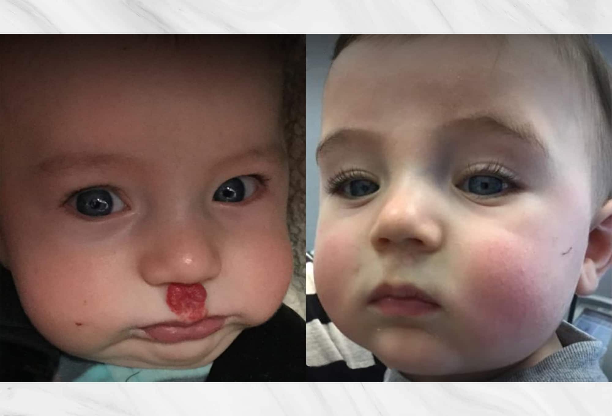 Hemangioma on the eyelids before and after results