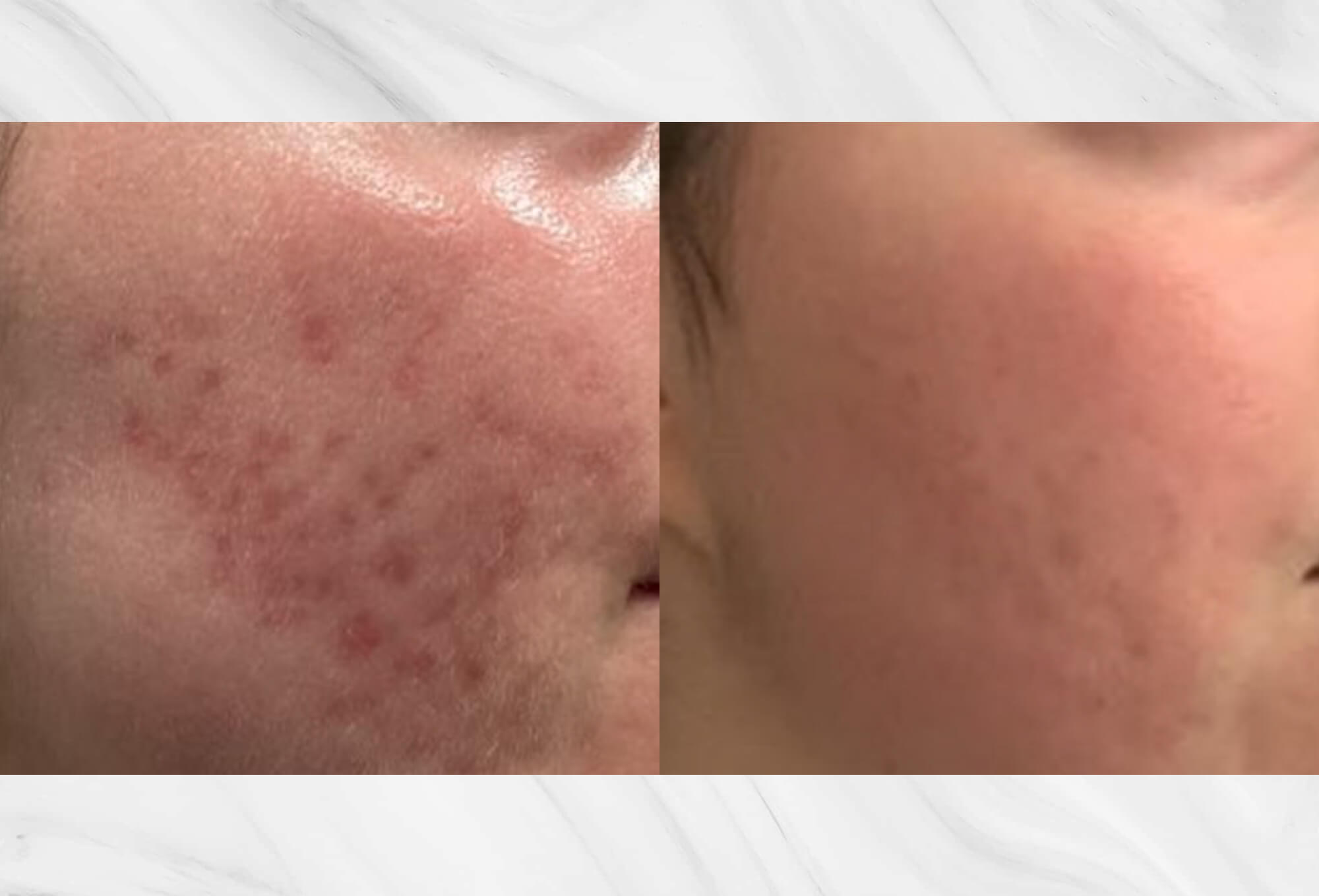 before and after image of microneedling for acne scar treatment