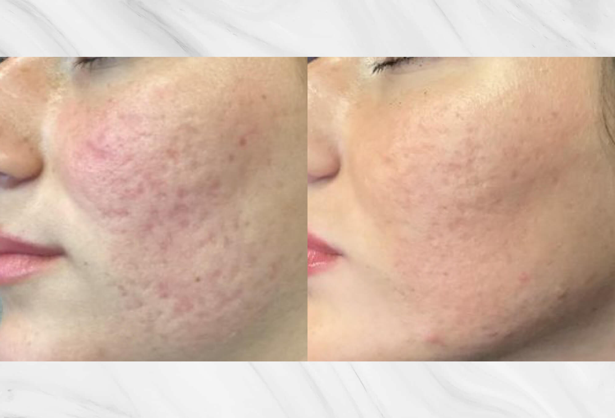 before and after image of patient who received microneedling for acne scar treatment