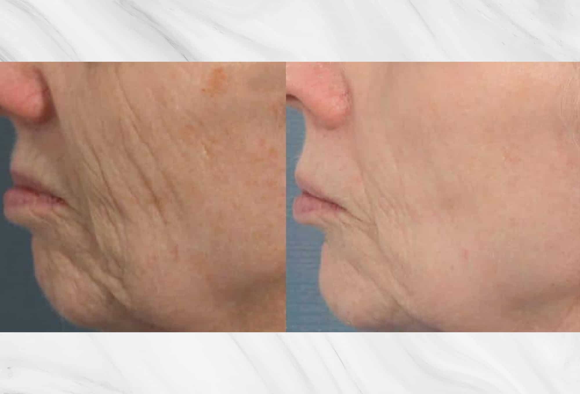 Lower face skin tightening patient before and after photos performed by Dr. Roy Geronemus