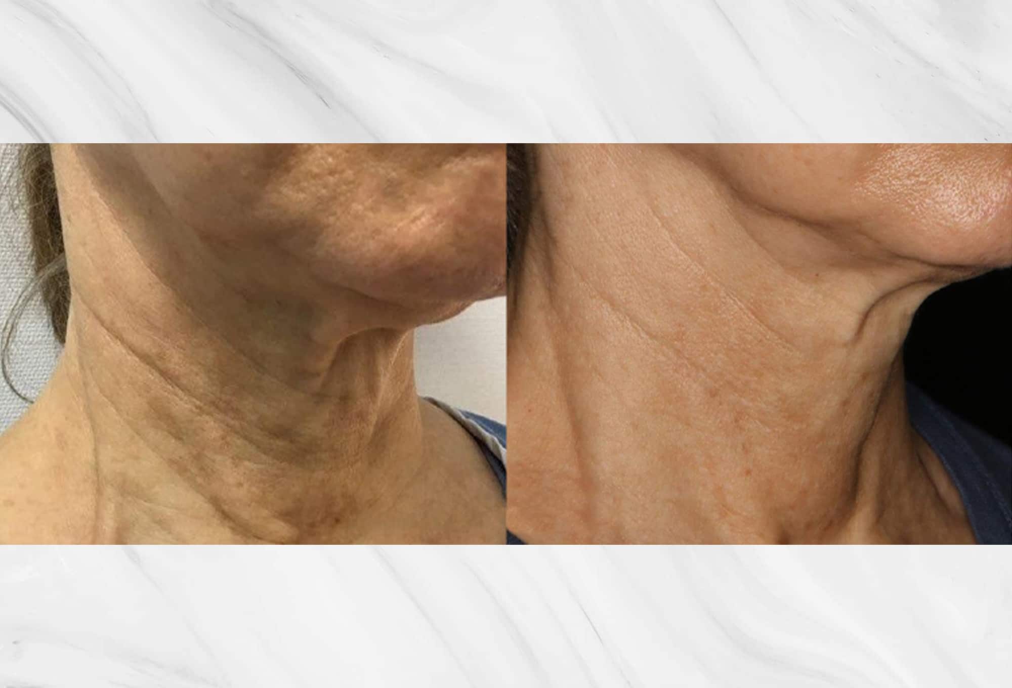Skin tightening results before and after photos of the neck by Dr. Roy Geronemus