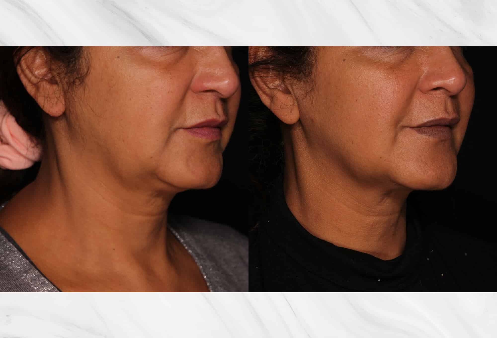 Sofwave skin tightening before & after image