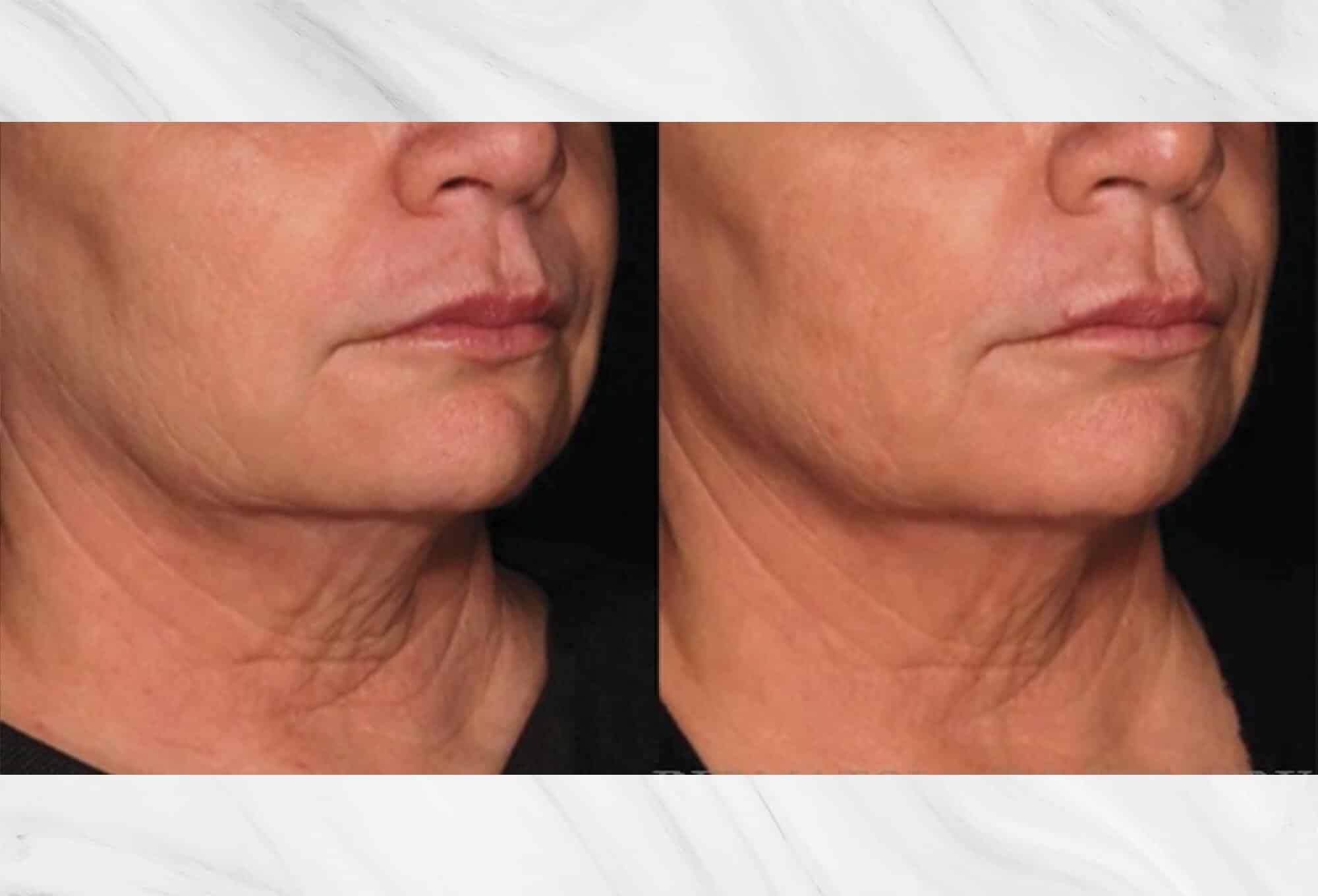 Sofwave skin tightening before & after image