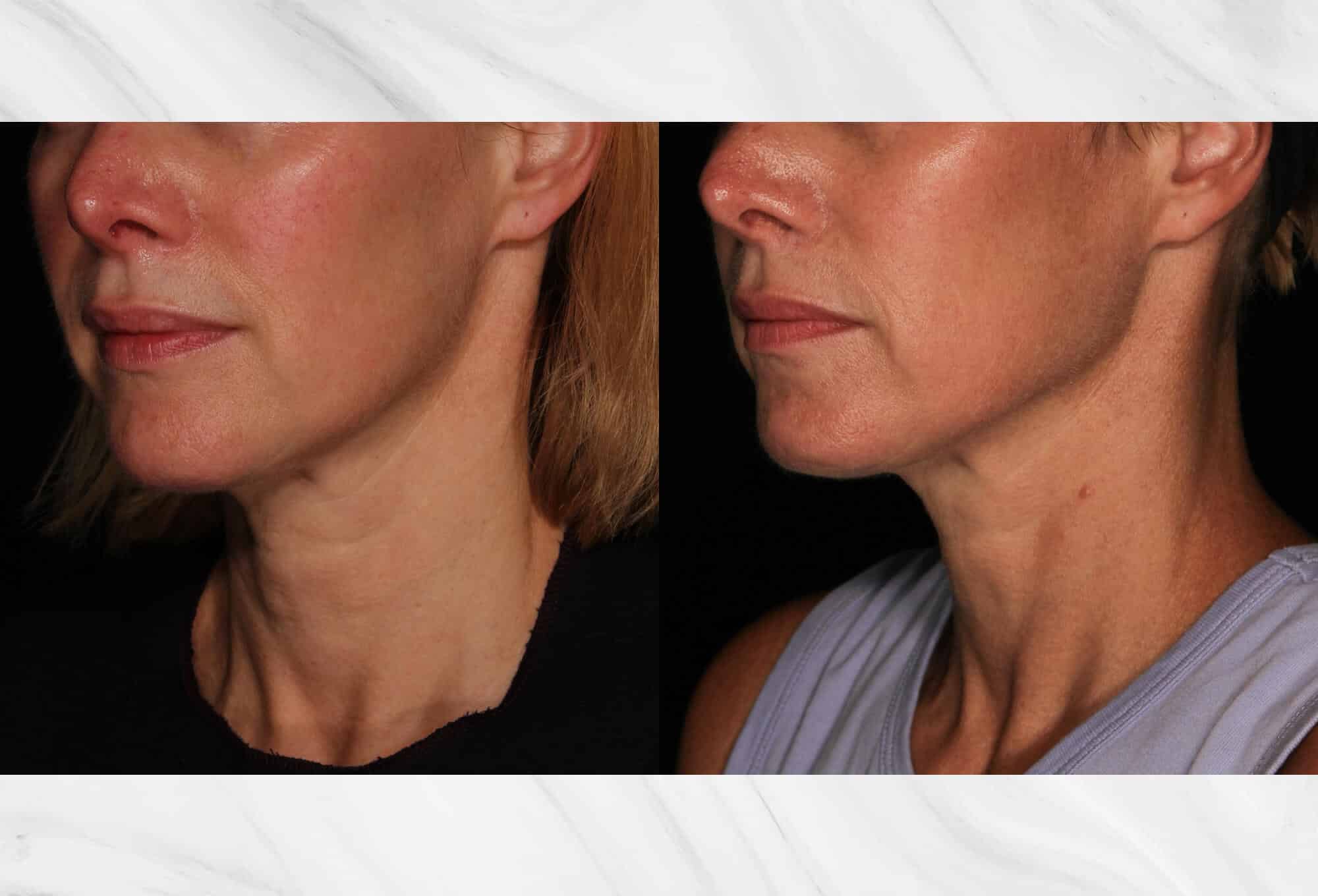 Sofwave skin tightening before and after image