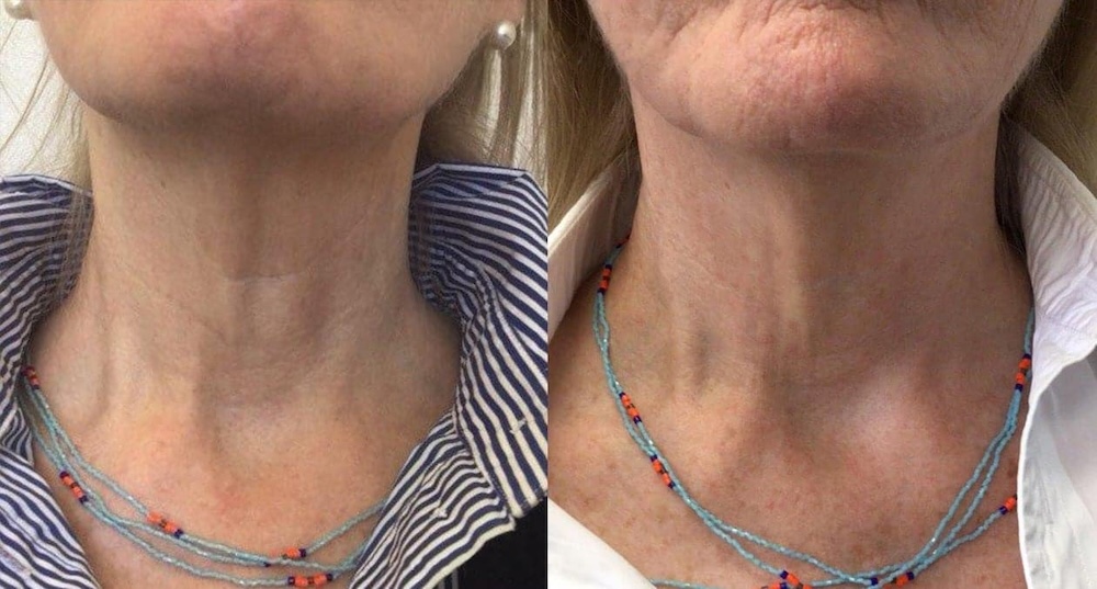 A close-up on a patient's neck, showing the immense difference between Sofwave before and after in NYC