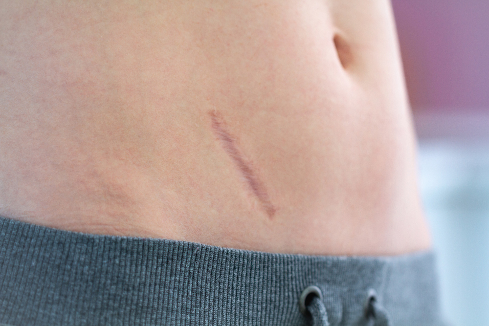Scars