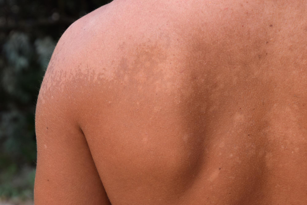 Sun Damage