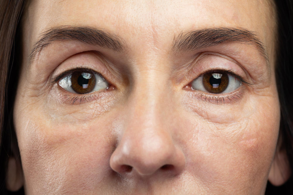Festoons (Upper Cheek Bags)