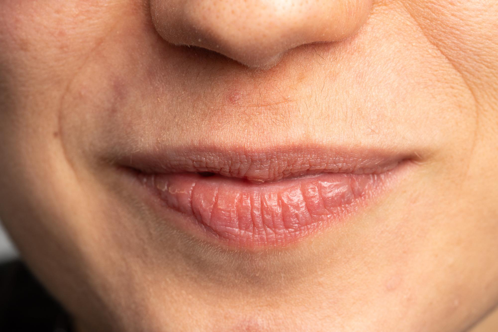 Lip Lines