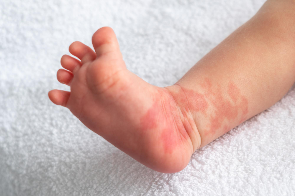 Birthmarks