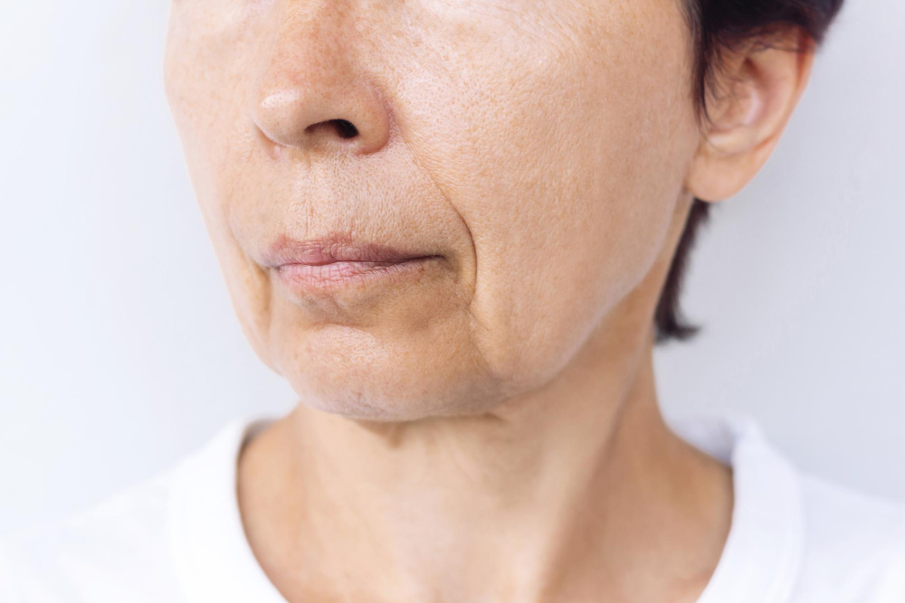 Aging Skin