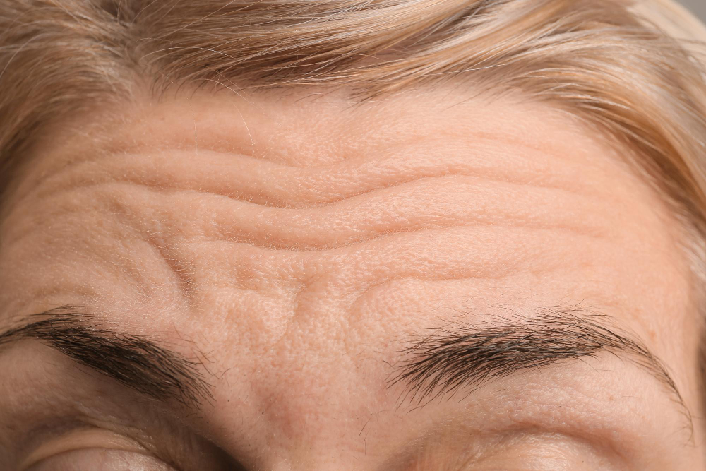 Wrinkles