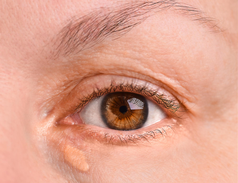 Xanthelasma (Cholesterol Deposits)