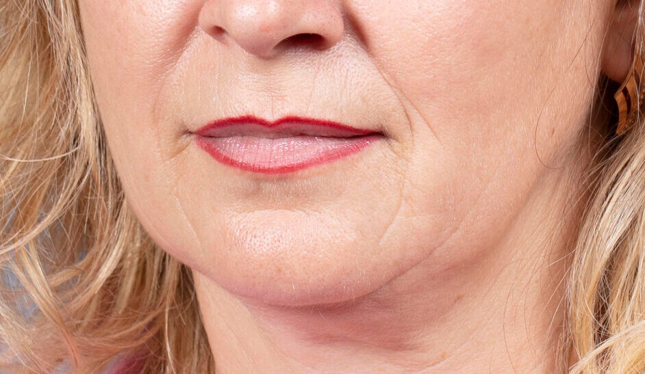 Permanent Makeup Removal