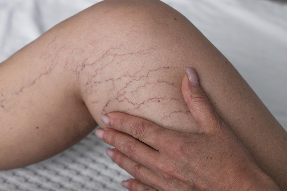 Reticular Veins