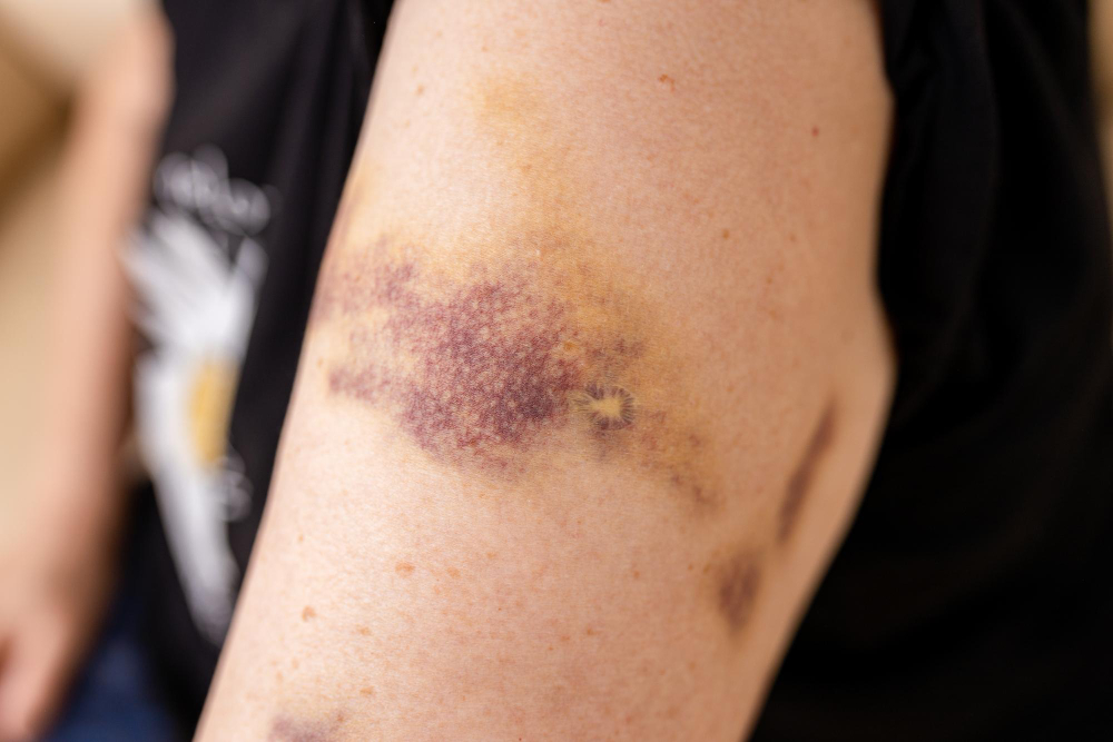 Bruising